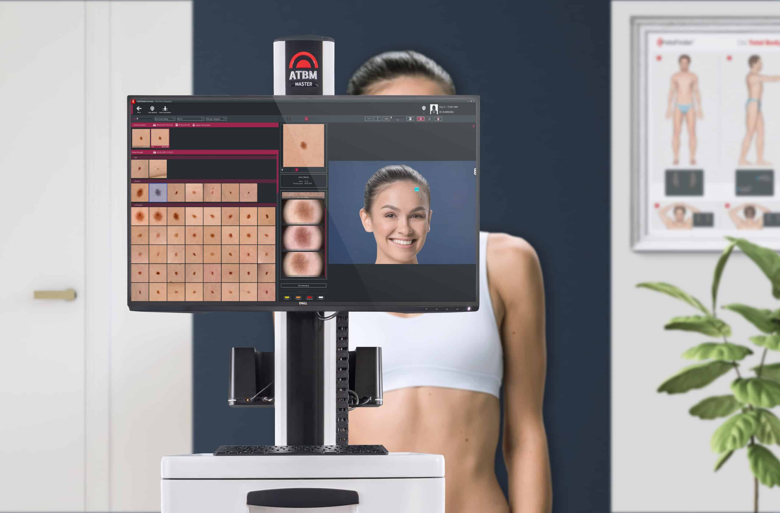 ATBM Master, Fotofinder, Muttermale